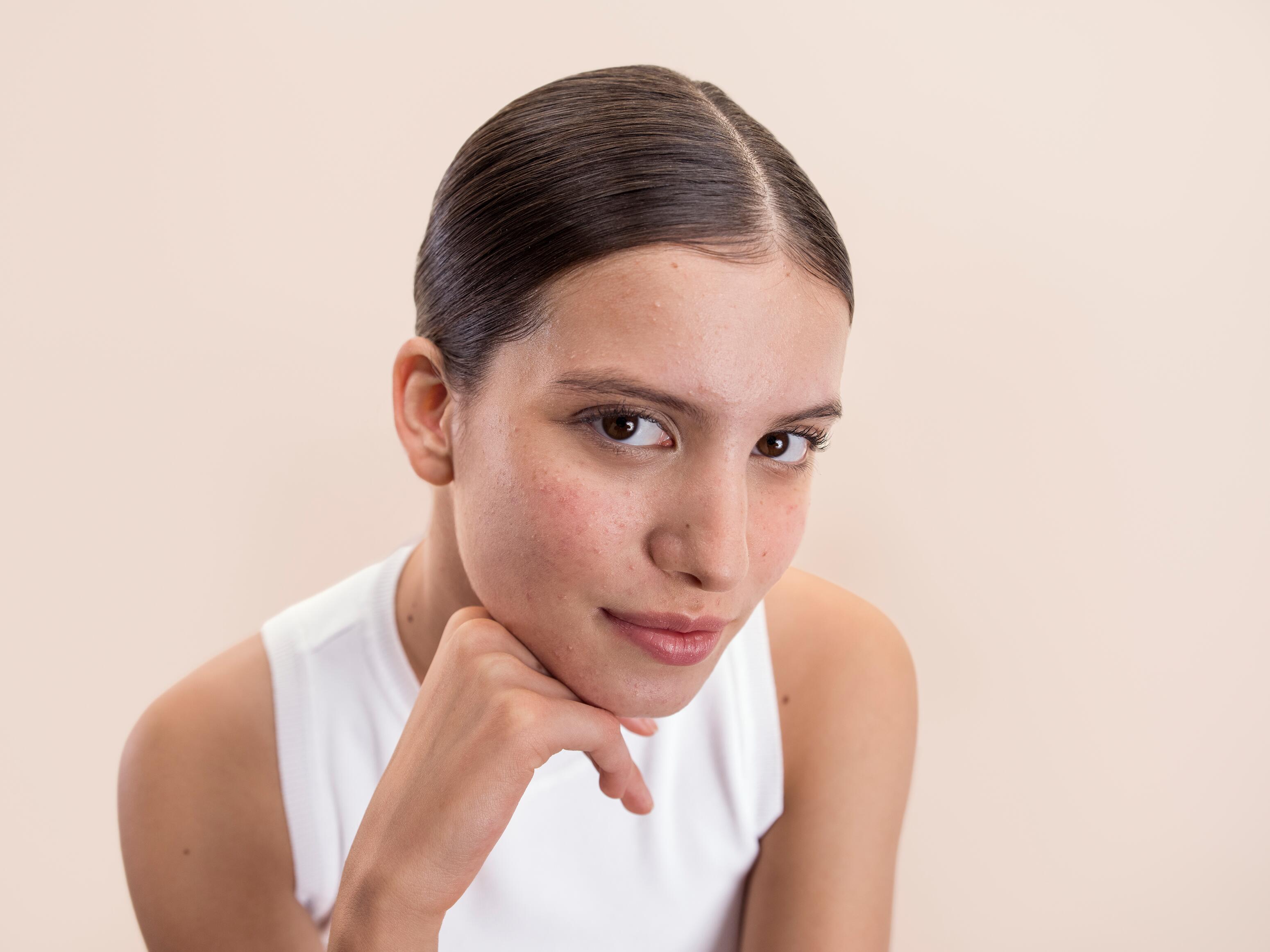 Causes boutons acné sur les lèvres